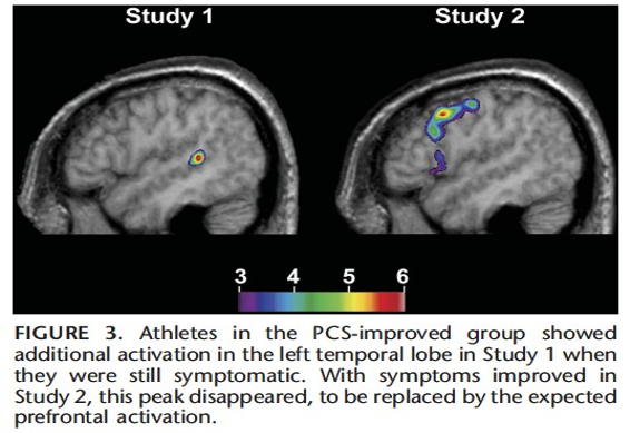 brain scans showing different areas of activation in the brain