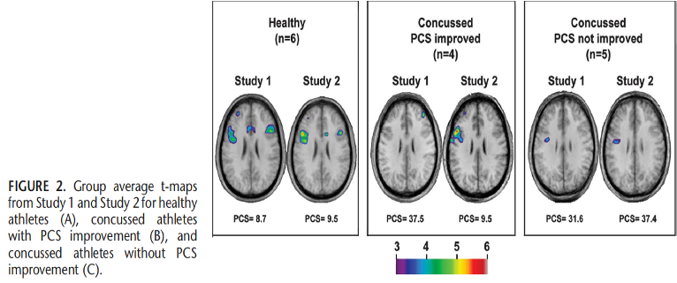 brain scans showing different activation after receiving brain rehab treatment