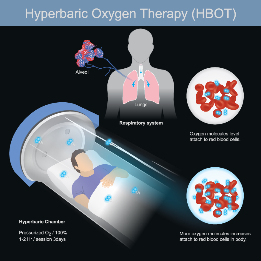 HBOT-Treatment Hyperbaric Oxygen Treatment (HBOT) showing oxygen saturated blood cells